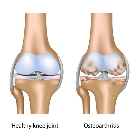 Osteoarthritic Knee1