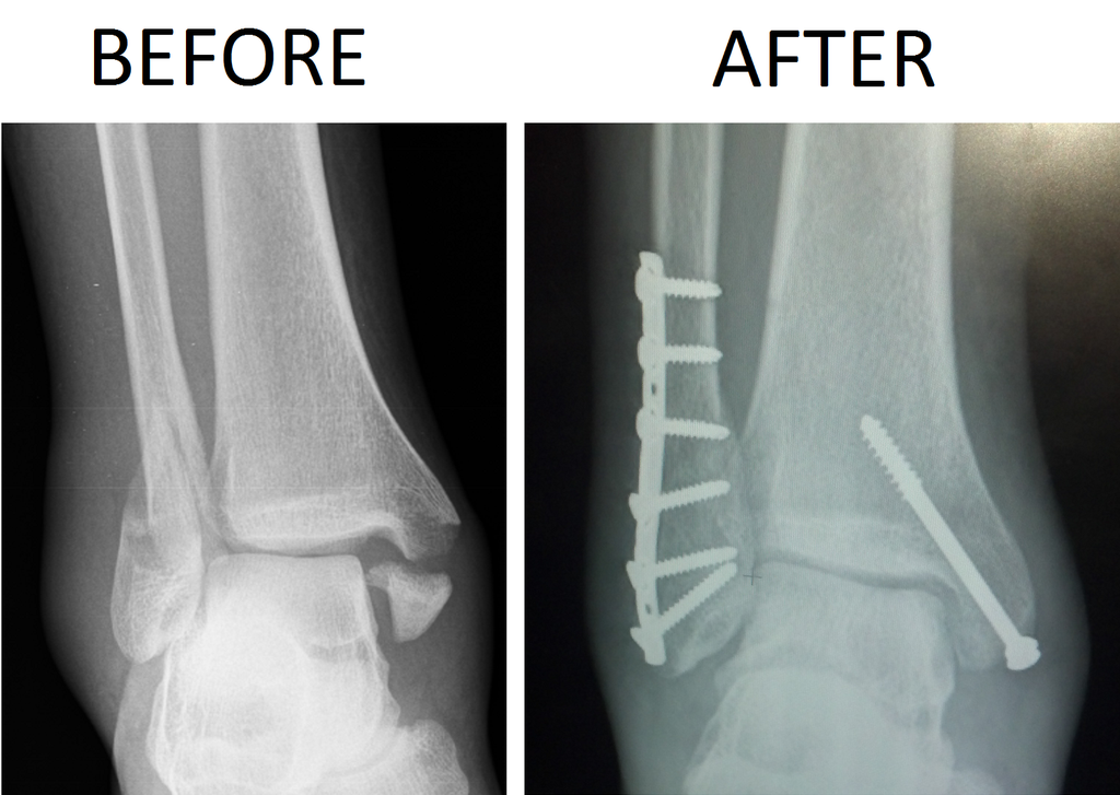 1024px-Trimalleolar_Ankle_Fracture_Xray_shown_before_surgery_and_after_surgery