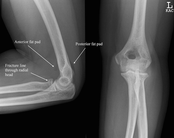 Radial Head Fractures