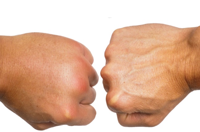 PHYSICAL THERAPY TREATMENT FOR EDEMA OR EFFUSION