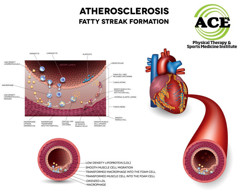 Peripheral Artery Disease 
